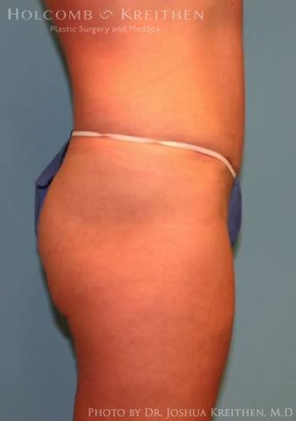 Tummy Tuck Gallery - Patient 6236476 - Image 4
