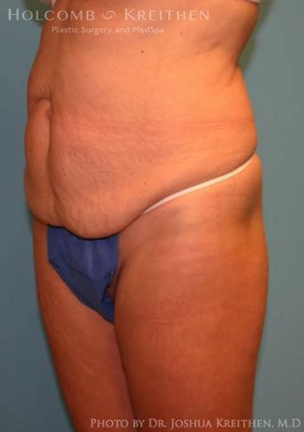 Tummy Tuck Before & After Gallery - Patient 6236476 - Image 5