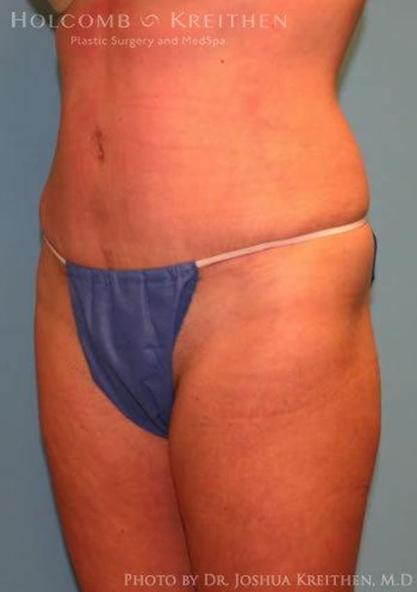 Tummy Tuck Before & After Gallery - Patient 6236476 - Image 6