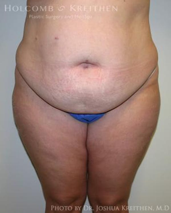 Tummy Tuck Before & After Gallery - Patient 6236480 - Image 1