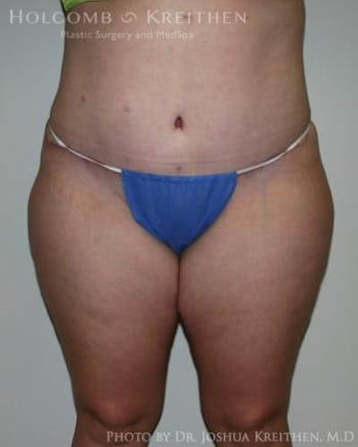 Tummy Tuck Before & After Gallery - Patient 6236480 - Image 2