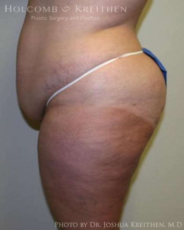 Tummy Tuck Before & After Gallery - Patient 6236480 - Image 3