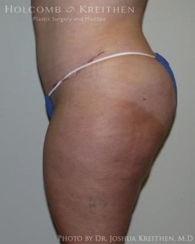 Tummy Tuck Before & After Gallery - Patient 6236480 - Image 4