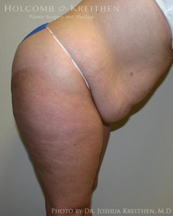 Tummy Tuck Before & After Gallery - Patient 6236480 - Image 5