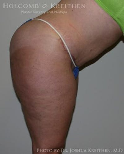 Tummy Tuck Gallery - Patient 6236480 - Image 6