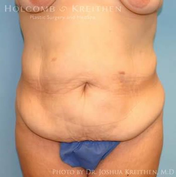 Tummy Tuck Gallery - Patient 6236484 - Image 1