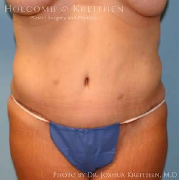 Tummy Tuck Before & After Gallery - Patient 6236484 - Image 2