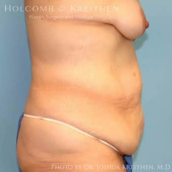 Tummy Tuck Before & After Gallery - Patient 6236484 - Image 3