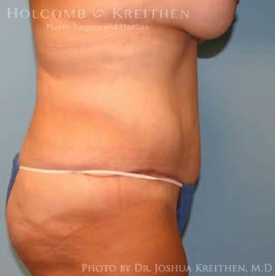 Tummy Tuck Before & After Gallery - Patient 6236484 - Image 4