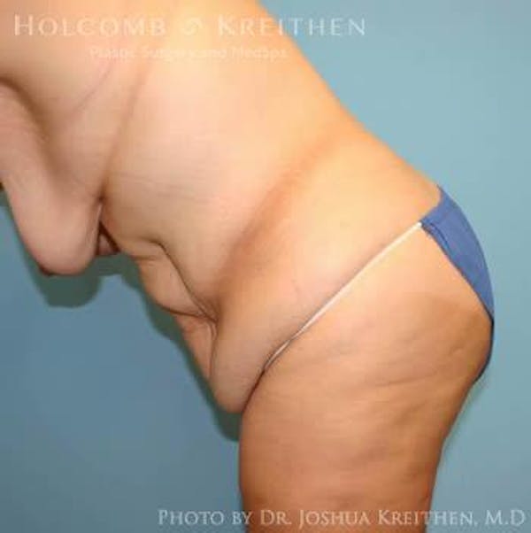 Tummy Tuck Before & After Gallery - Patient 6236484 - Image 5