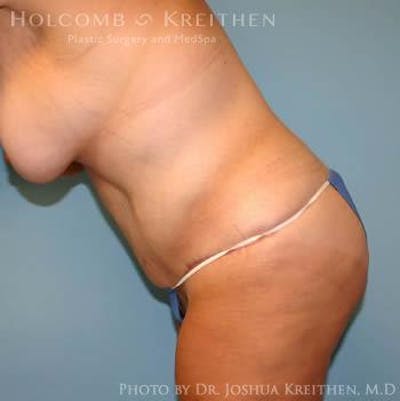 Tummy Tuck Before & After Gallery - Patient 6236484 - Image 6