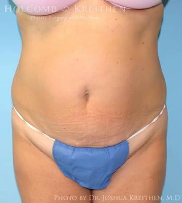 Tummy Tuck Before & After Gallery - Patient 6236489 - Image 1