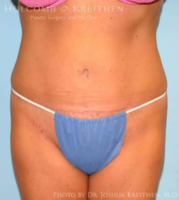 Tummy Tuck Before & After Gallery - Patient 6236489 - Image 2