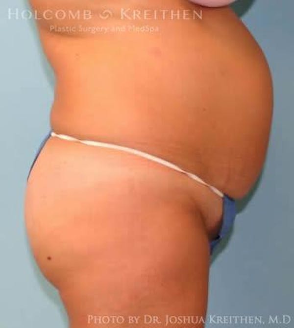 Tummy Tuck Before & After Gallery - Patient 6236489 - Image 3