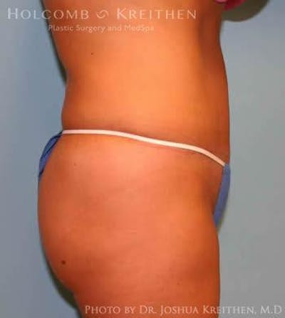 Tummy Tuck Before & After Gallery - Patient 6236489 - Image 4