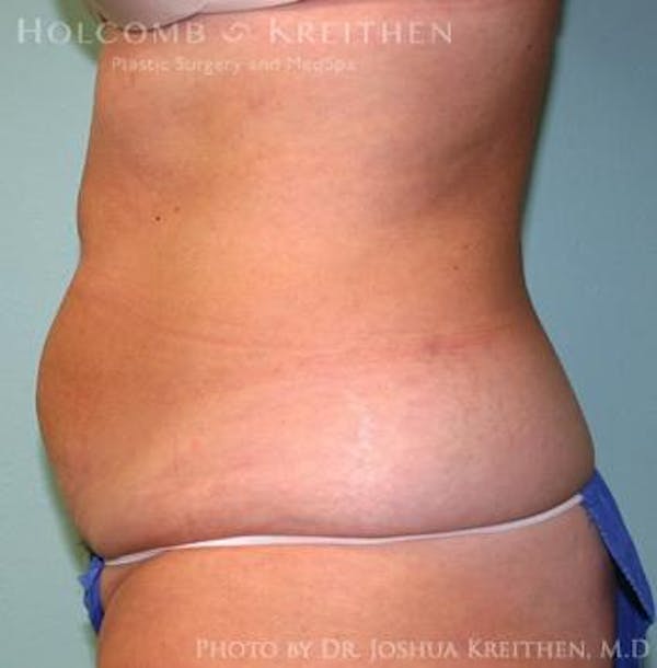 Liposuction Before & After Gallery - Patient 6236511 - Image 1
