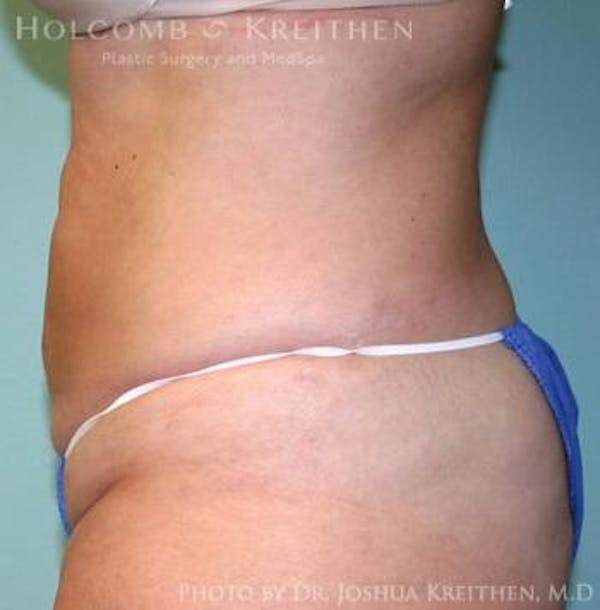 Liposuction Before & After Gallery - Patient 6236511 - Image 2