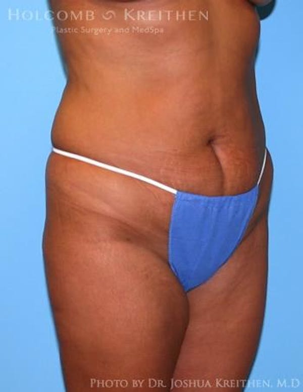 Liposuction Gallery - Patient 6236512 - Image 1