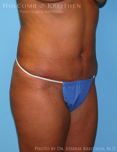 Liposuction Before & After Gallery - Patient 6236512 - Image 2