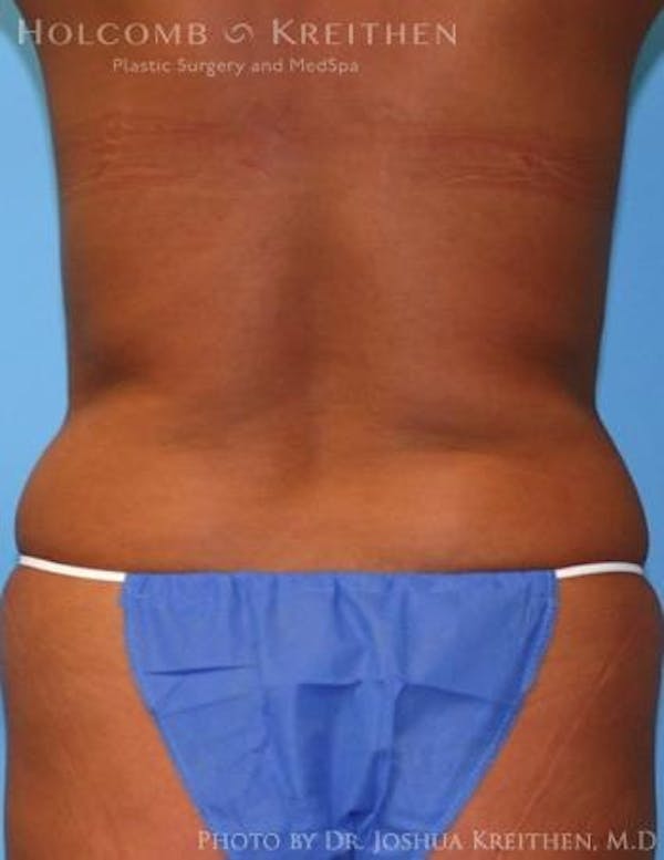Liposuction Gallery - Patient 6236512 - Image 3