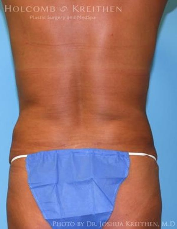 Liposuction Gallery - Patient 6236512 - Image 4