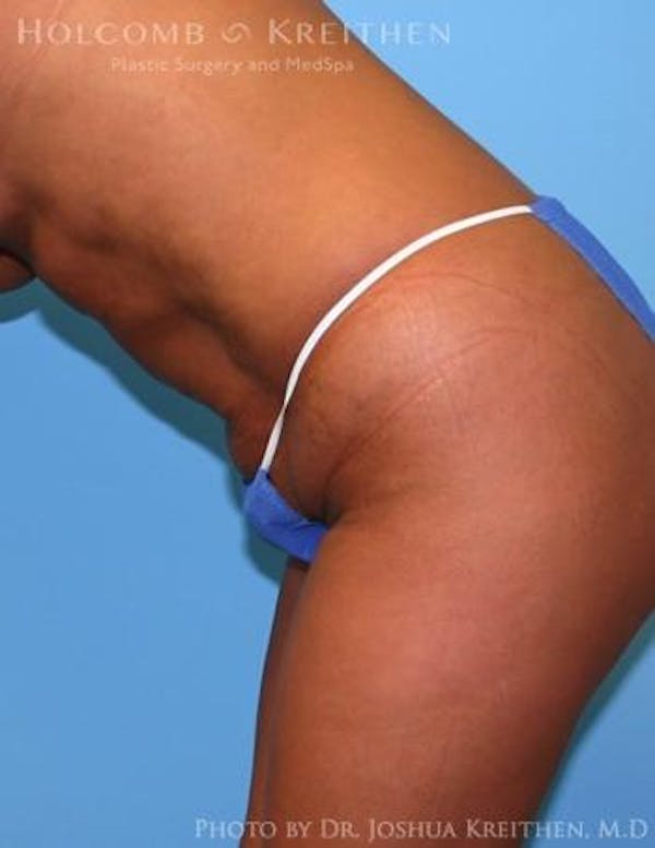 Liposuction Before & After Gallery - Patient 6236512 - Image 5