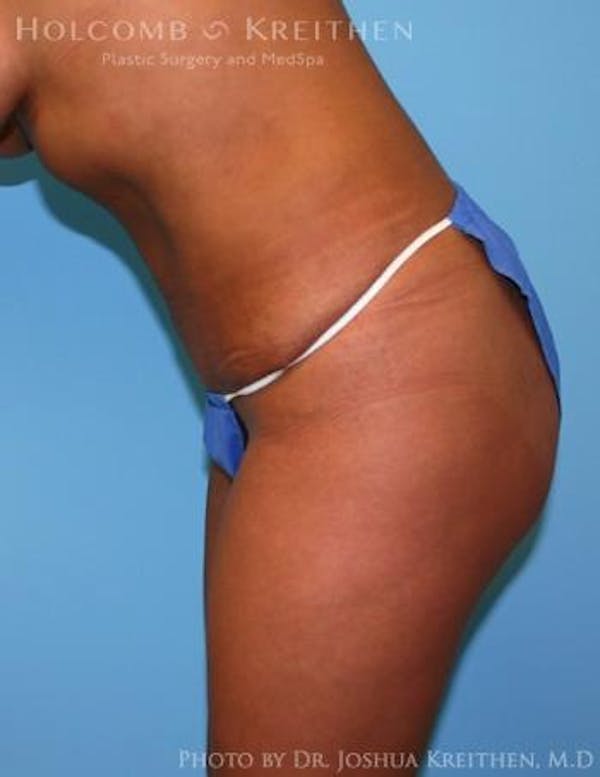 Liposuction Before & After Gallery - Patient 6236512 - Image 6