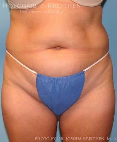 Liposuction Before & After Gallery - Patient 6236513 - Image 1