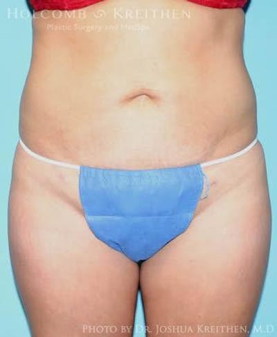 Liposuction Gallery - Patient 6236513 - Image 2