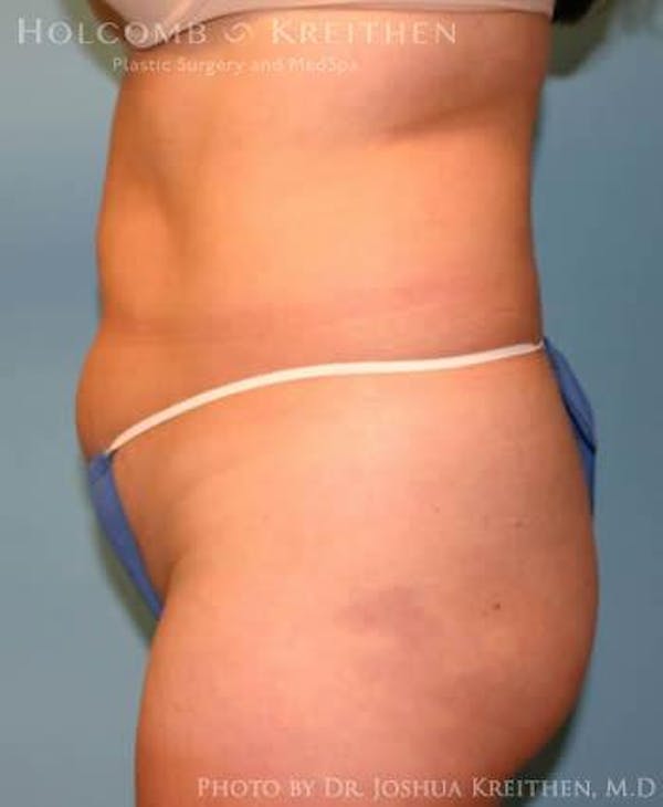 Liposuction Before & After Gallery - Patient 6236513 - Image 3