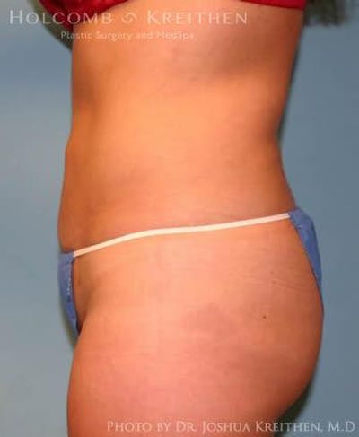 Liposuction Before & After Gallery - Patient 6236513 - Image 4
