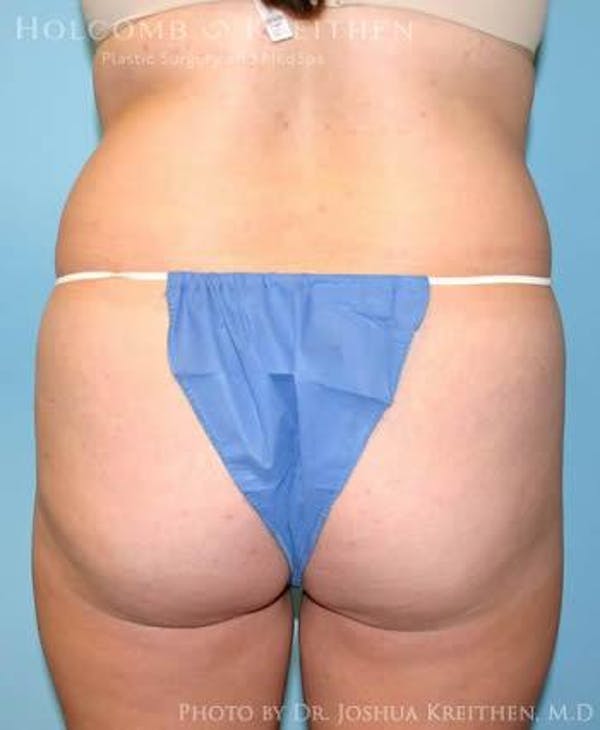 Liposuction Before & After Gallery - Patient 6236513 - Image 5