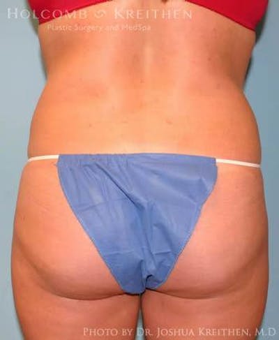 Liposuction Gallery - Patient 6236513 - Image 6