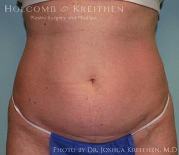 Liposuction Before & After Gallery - Patient 6236516 - Image 1
