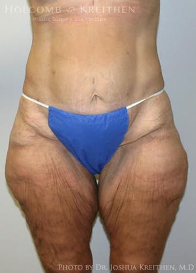 Lower Body Lift Before & After Gallery - Patient 6236517 - Image 1