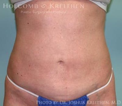 Liposuction Gallery - Patient 6236516 - Image 2