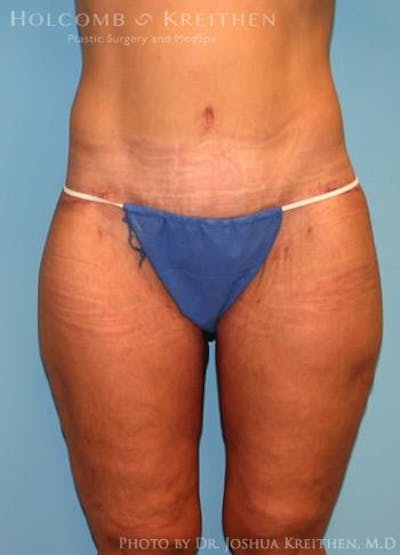 Lower Body Lift Before & After Gallery - Patient 6236517 - Image 2
