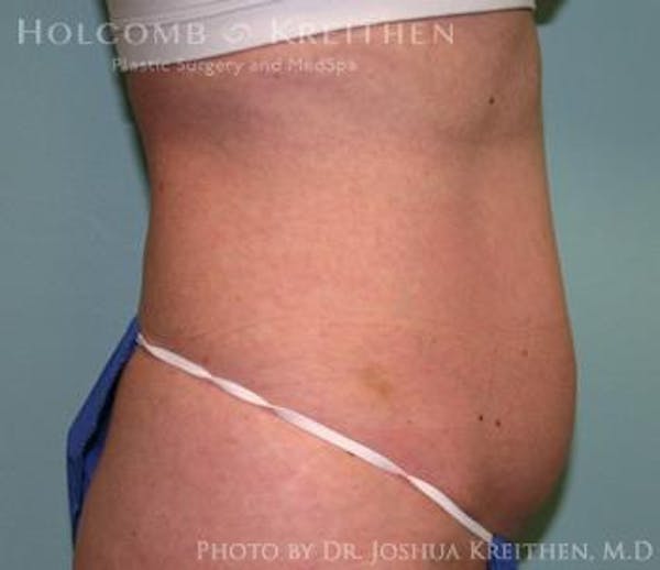 Liposuction Before & After Gallery - Patient 6236516 - Image 3