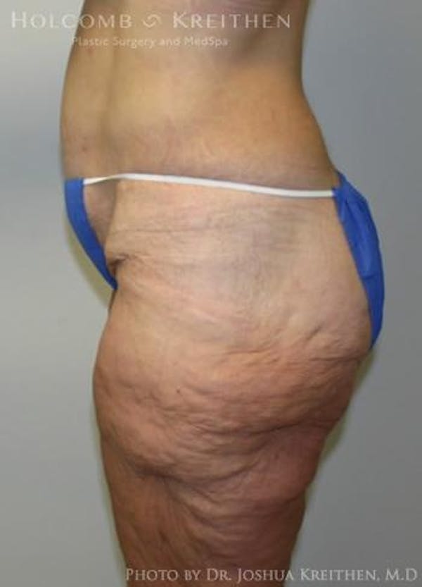 Lower Body Lift Before & After Gallery - Patient 6236517 - Image 3