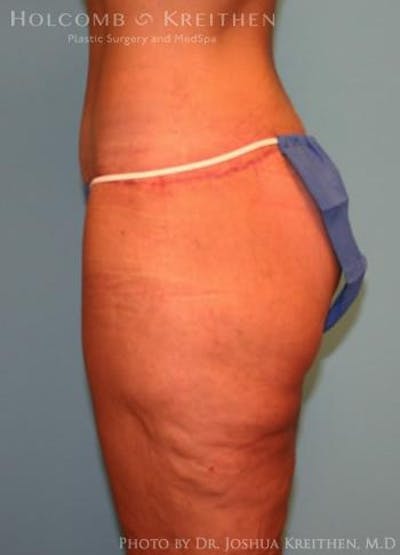 Lower Body Lift Before & After Gallery - Patient 6236517 - Image 4