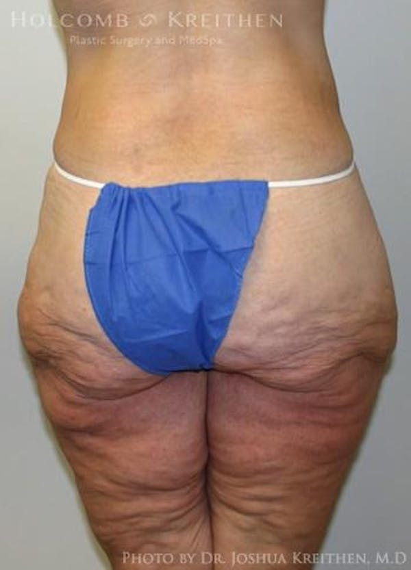 Lower Body Lift Before & After Gallery - Patient 6236517 - Image 5
