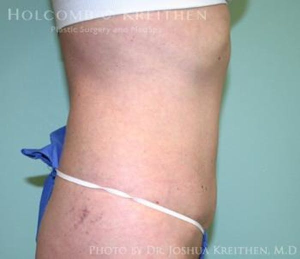 Liposuction Before & After Gallery - Patient 6236516 - Image 4
