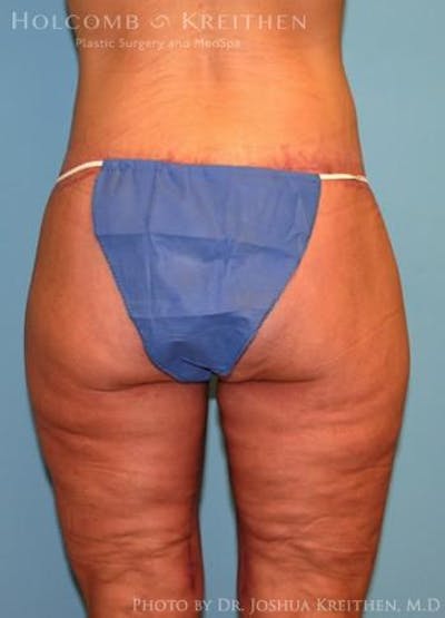 Lower Body Lift Before & After Gallery - Patient 6236517 - Image 6