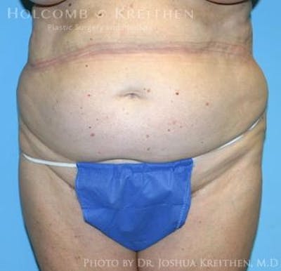 Liposuction Before & After Gallery - Patient 6236518 - Image 1