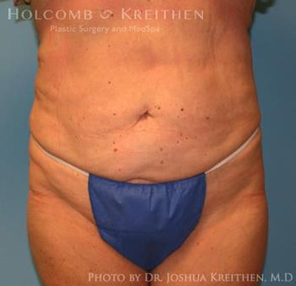 Liposuction Before & After Gallery - Patient 6236518 - Image 2
