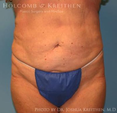 Liposuction Before & After Gallery - Patient 6236518 - Image 2