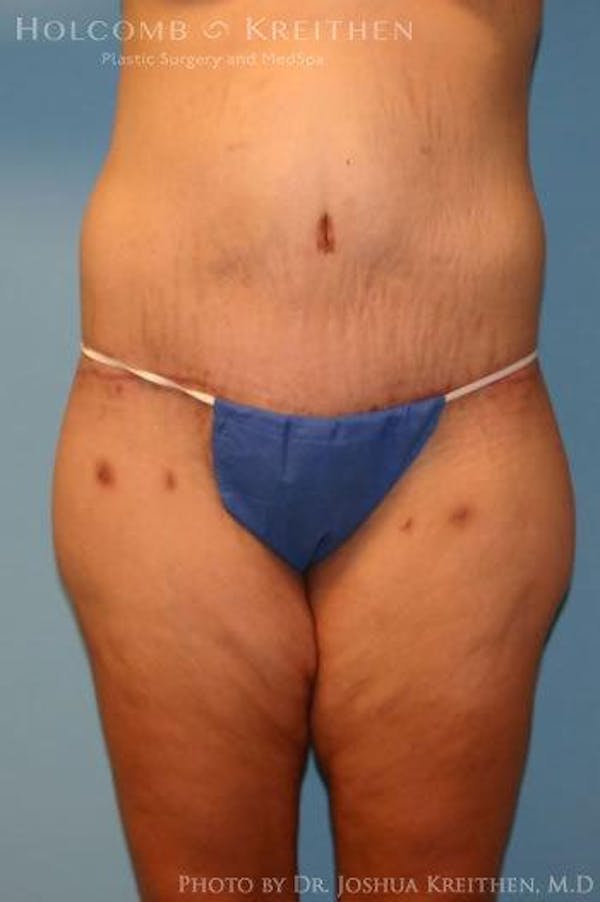 Lower Body Lift Before & After Gallery - Patient 6236519 - Image 2