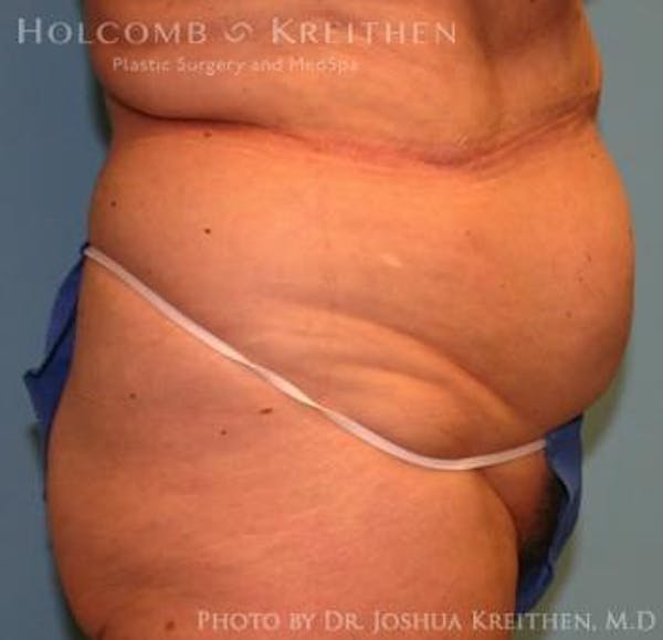 Liposuction Gallery - Patient 6236518 - Image 3