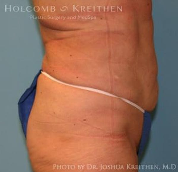 Liposuction Before & After Gallery - Patient 6236518 - Image 4