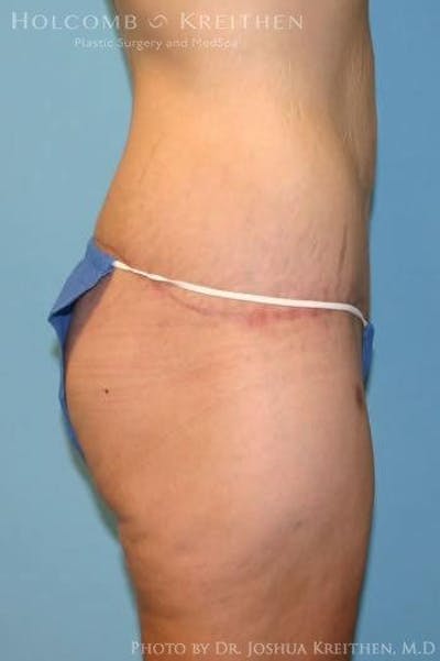 Lower Body Lift Before & After Gallery - Patient 6236519 - Image 4